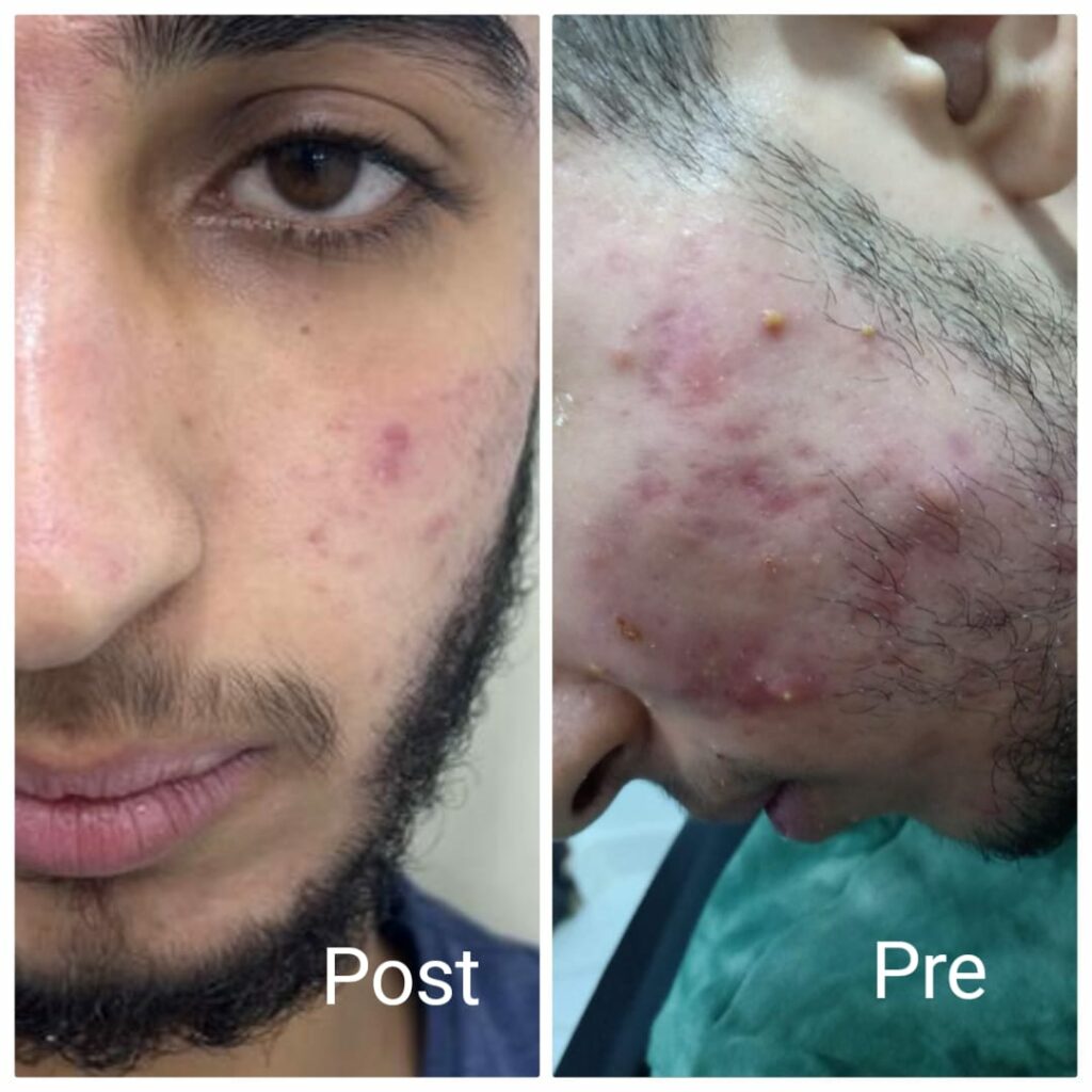 Laser acne treatment and removal