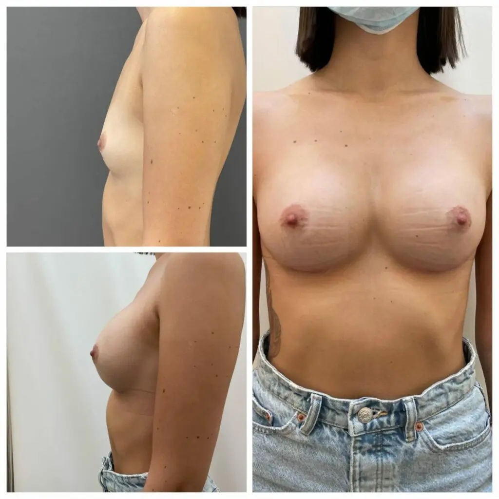 Breast augmentation and breast augmentation with silicone implants