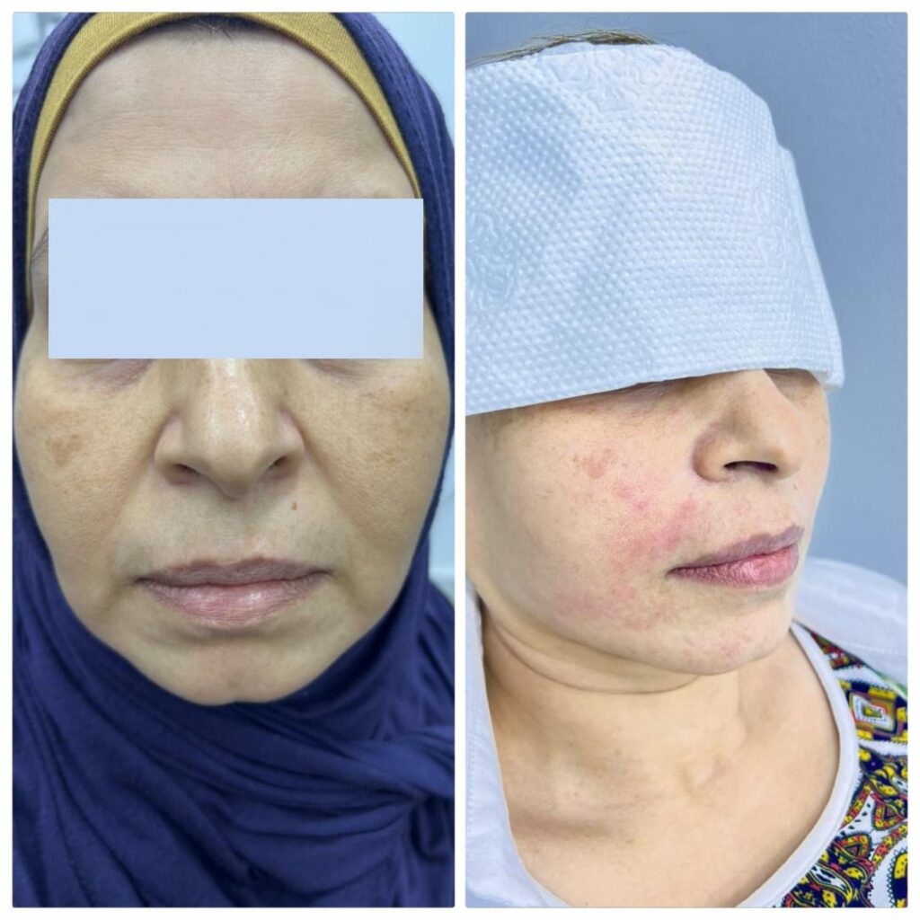 Rejuvenation of the face while eliminating skin problems, lifting sagging cheeks