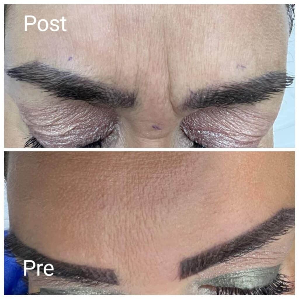 إزالة علامة الغضب بالبوتكس