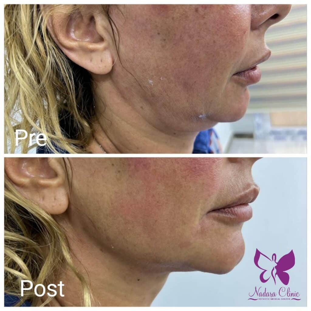 العناية بالبشرة المتهدله ونحت الفك والذقن