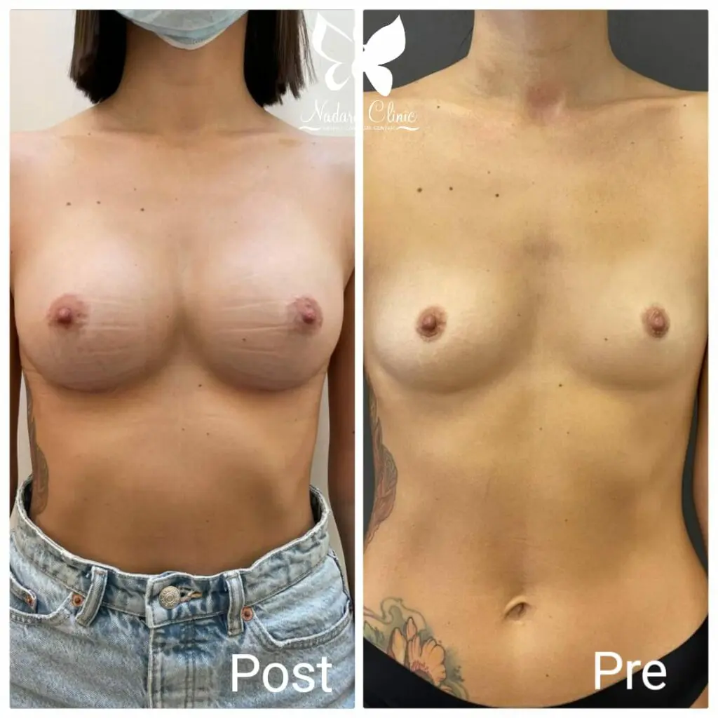 تجميل و تكبير الثدي 