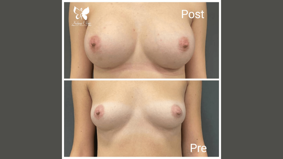 Breast augmentation in Hurghada