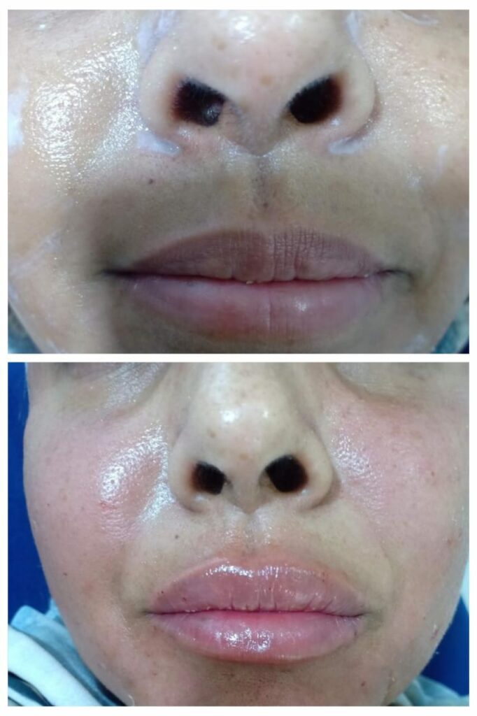 توريد الشفايف والخدود بالفيلر