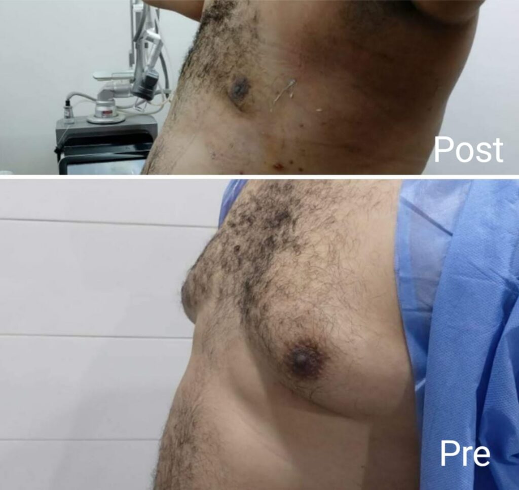Breast reduction and gynecomastia surgery for men