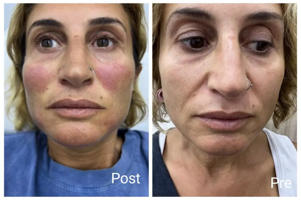 Profhilo injection before and after