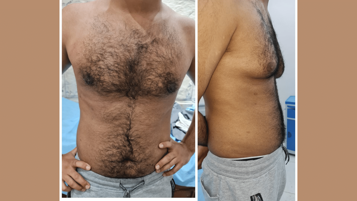 Gynecomastia treatment for men in Hurghada