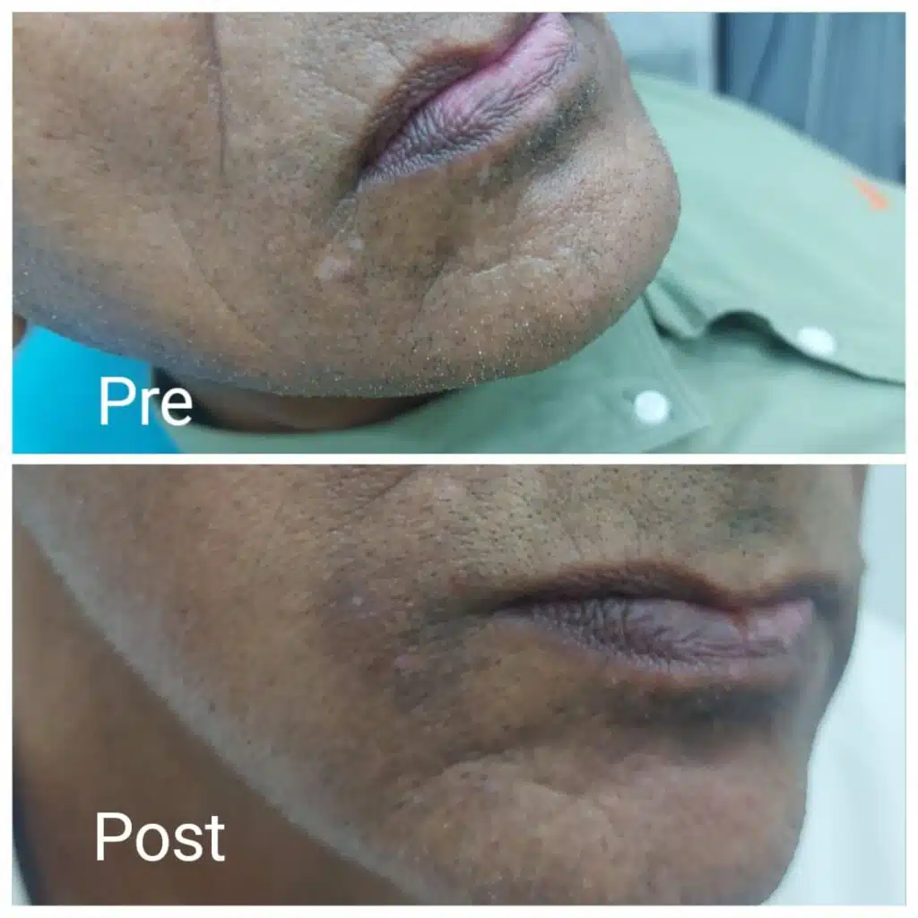 Vitiligo treatment after 3 laser sessions