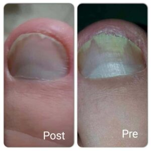 علاج فطريات أظافر القدم أو الفطر الظفري في الغردقة