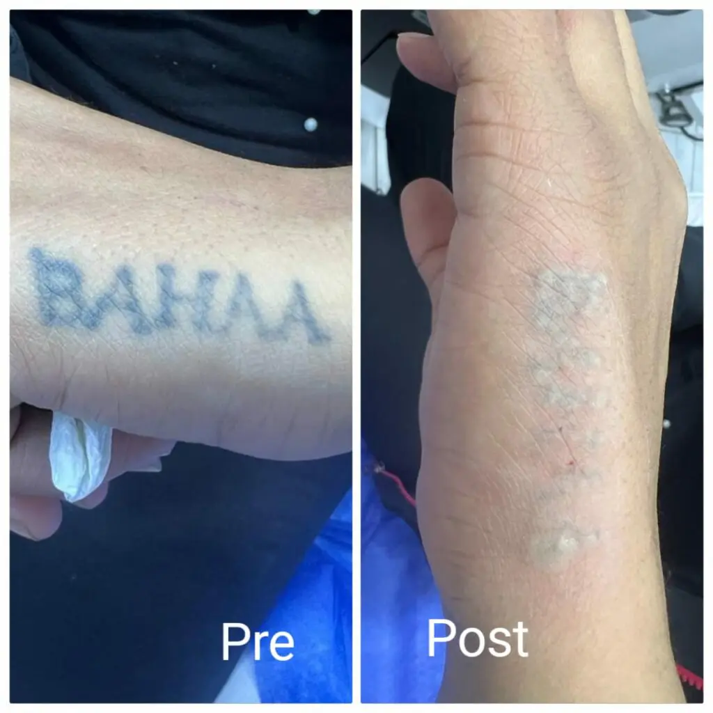 Immediate result of the first session of laser tattoo removal in Hurghada