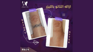 Laser tattoo removal and removal at Nadara Center for Dermatology, Laser and Cosmetology in Hurghada