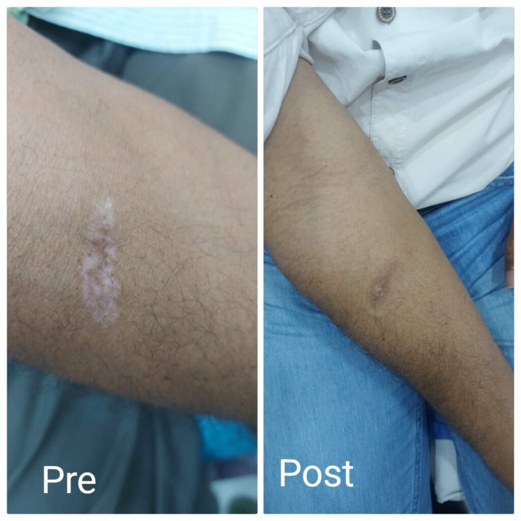 استعادة اللون الطبيعي للجلد بعد 5 جلسات