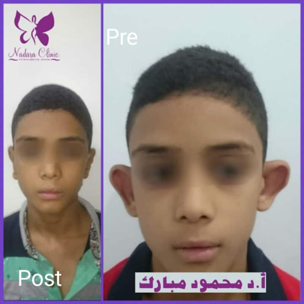 افضل دكتور جراحة تجميل الأذن