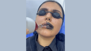 Carbon dioxide laser in Hurghada