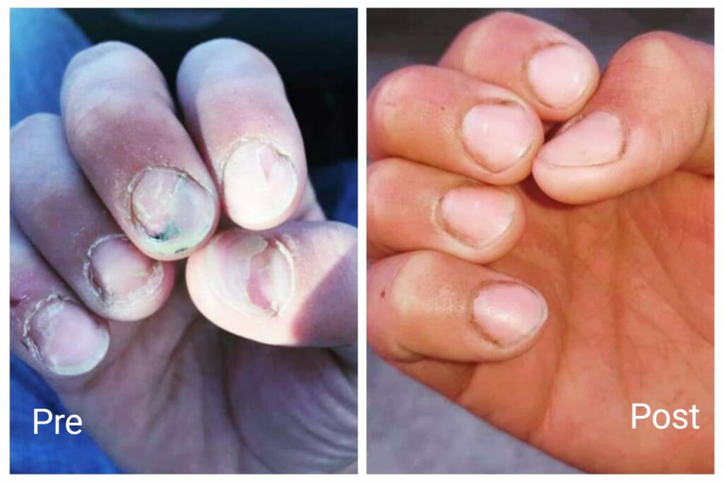 علاج فطر الأظافر مع أفضل دكتور علاج فطريات الاظافر 