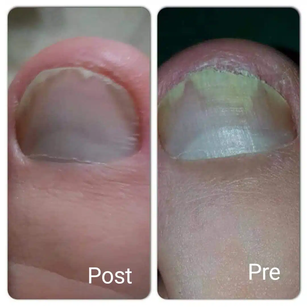 Treatment of toenail fungus or hands in Hurghada