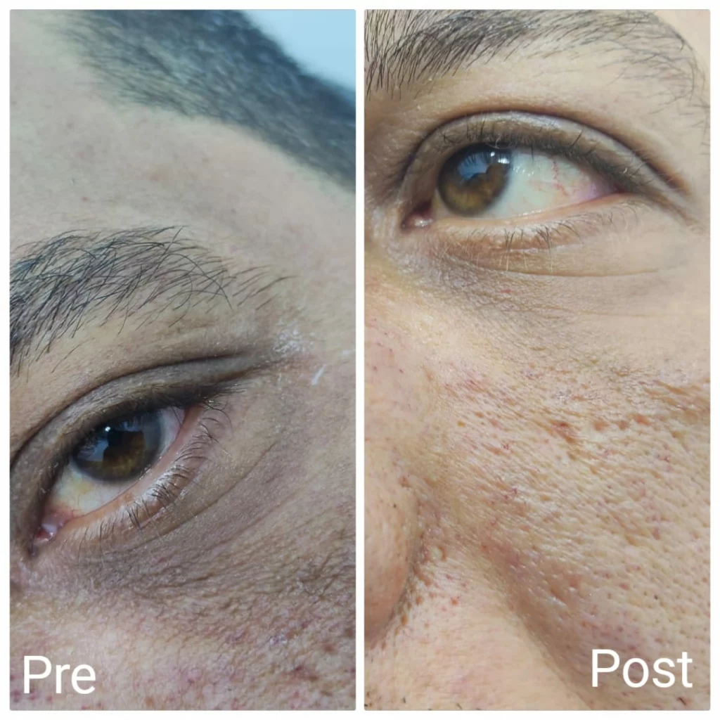 Instant improvement in dark circles under the eyes for men