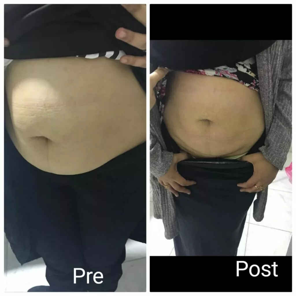 The result after a month of fat dissolving process