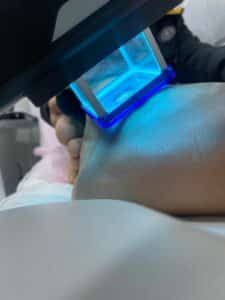 Excimer laser for psoriasis treatment with the best dermatologist