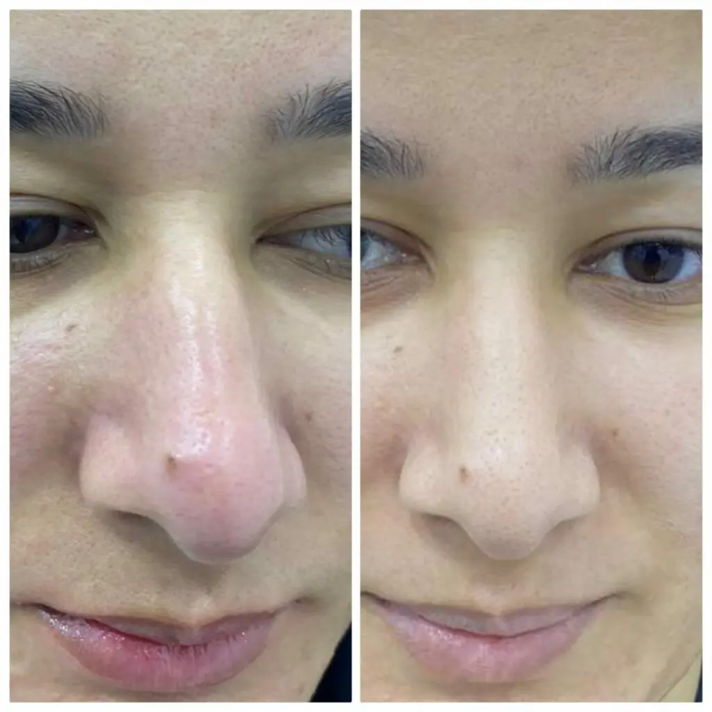 Removing blackheads in the nose in a deep skin cleansing session