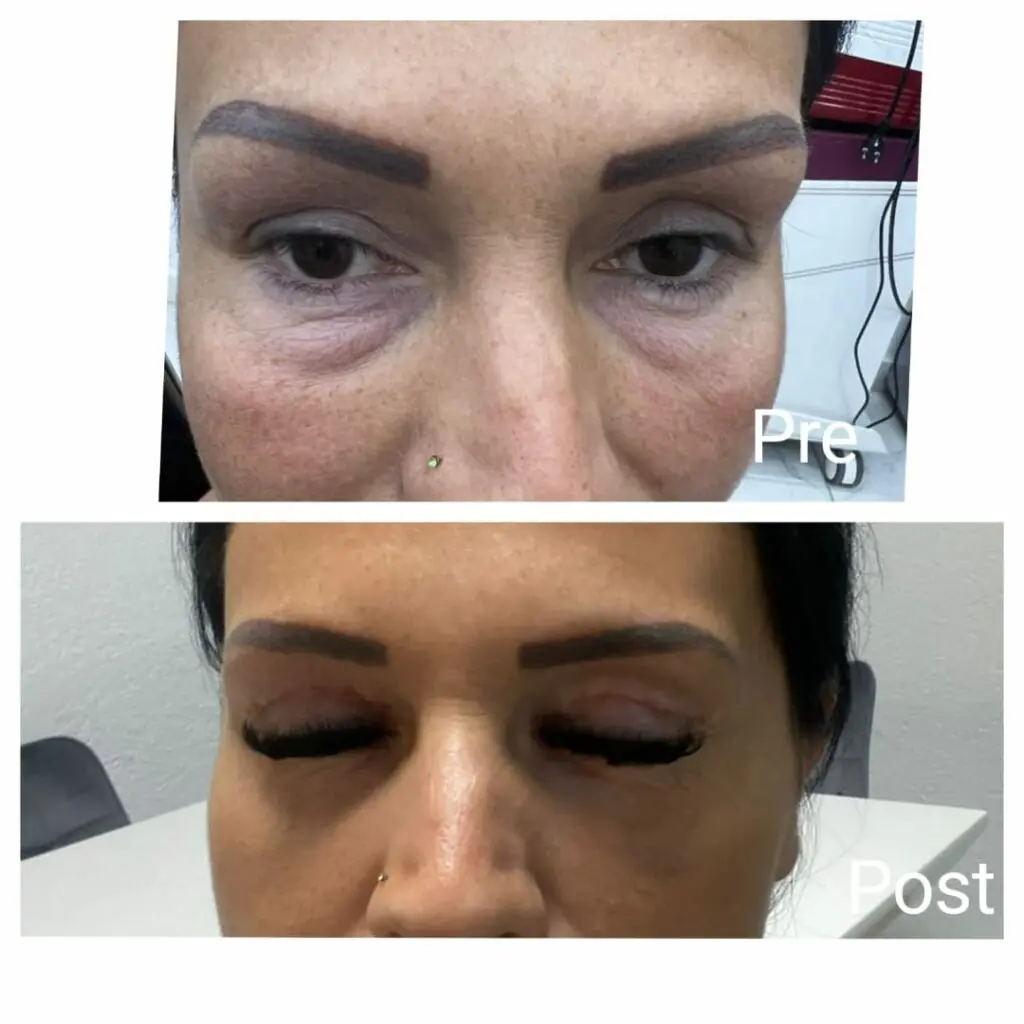 Eyelid lift before and after