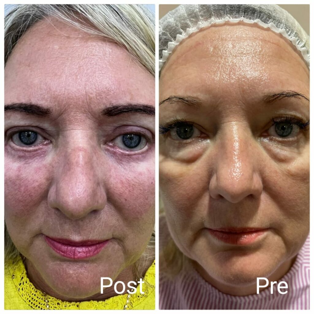 Eyelid lift before and after