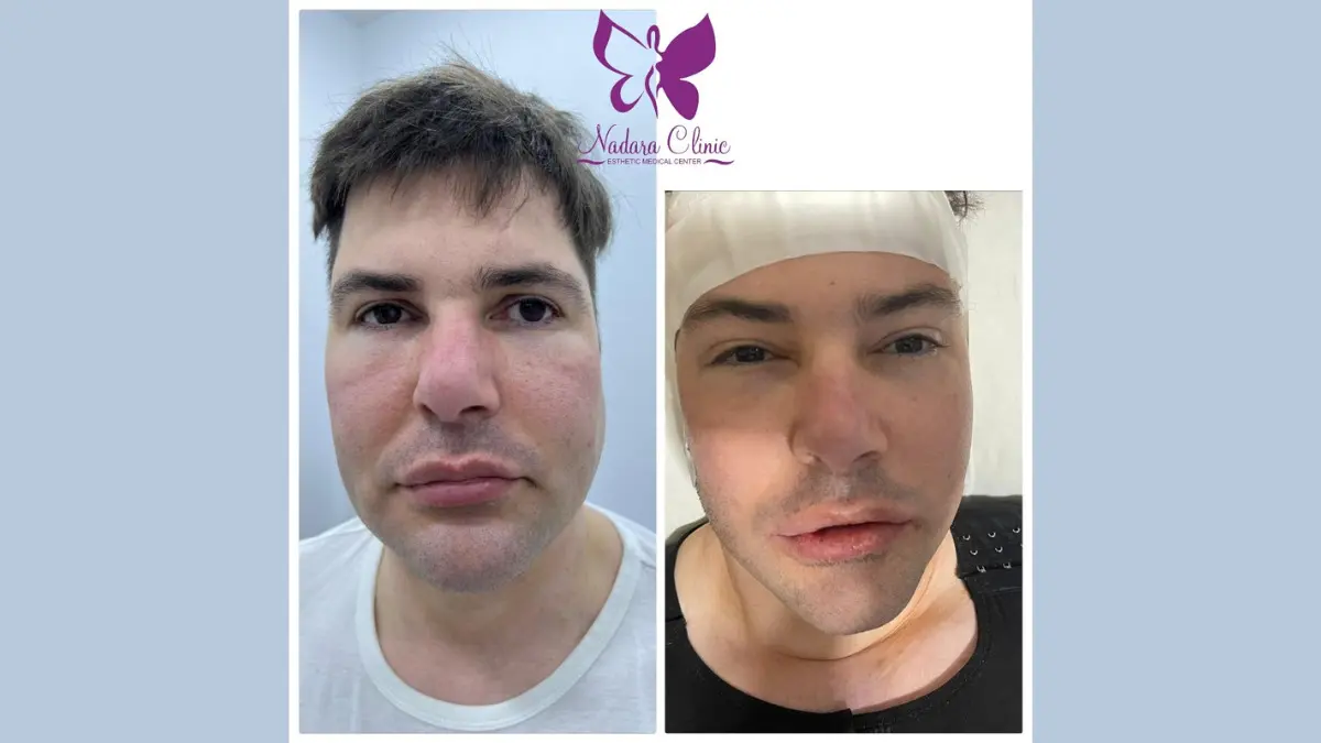 Facelift surgery in Hurghada