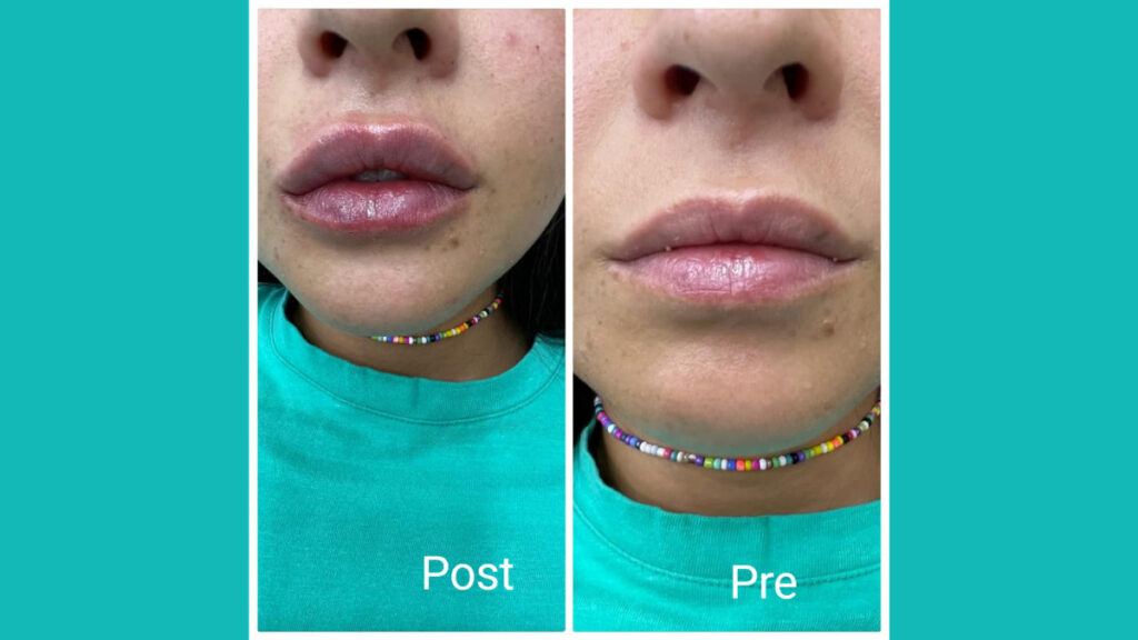Lip contouring filler in Hurghada
