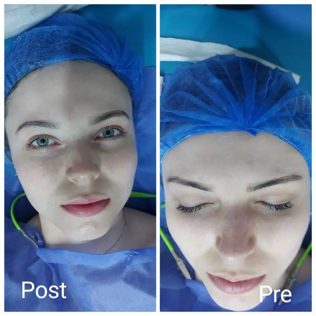 Results of a deep skin cleansing session