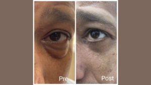Eyelid lift in Hurghada and removal of bags under the eyes