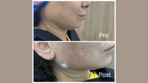 Double chin treatment in Hurghada