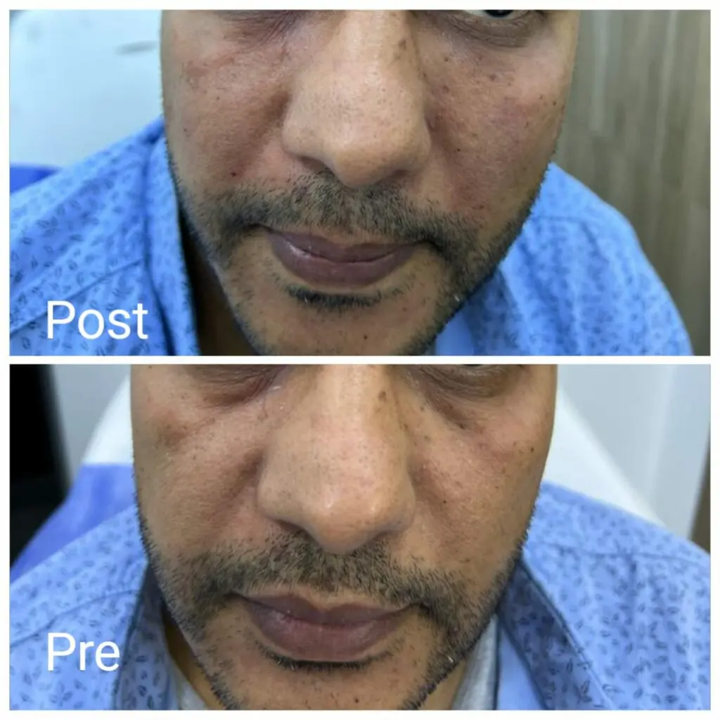 Plasma filler under the eyes and cheeks
