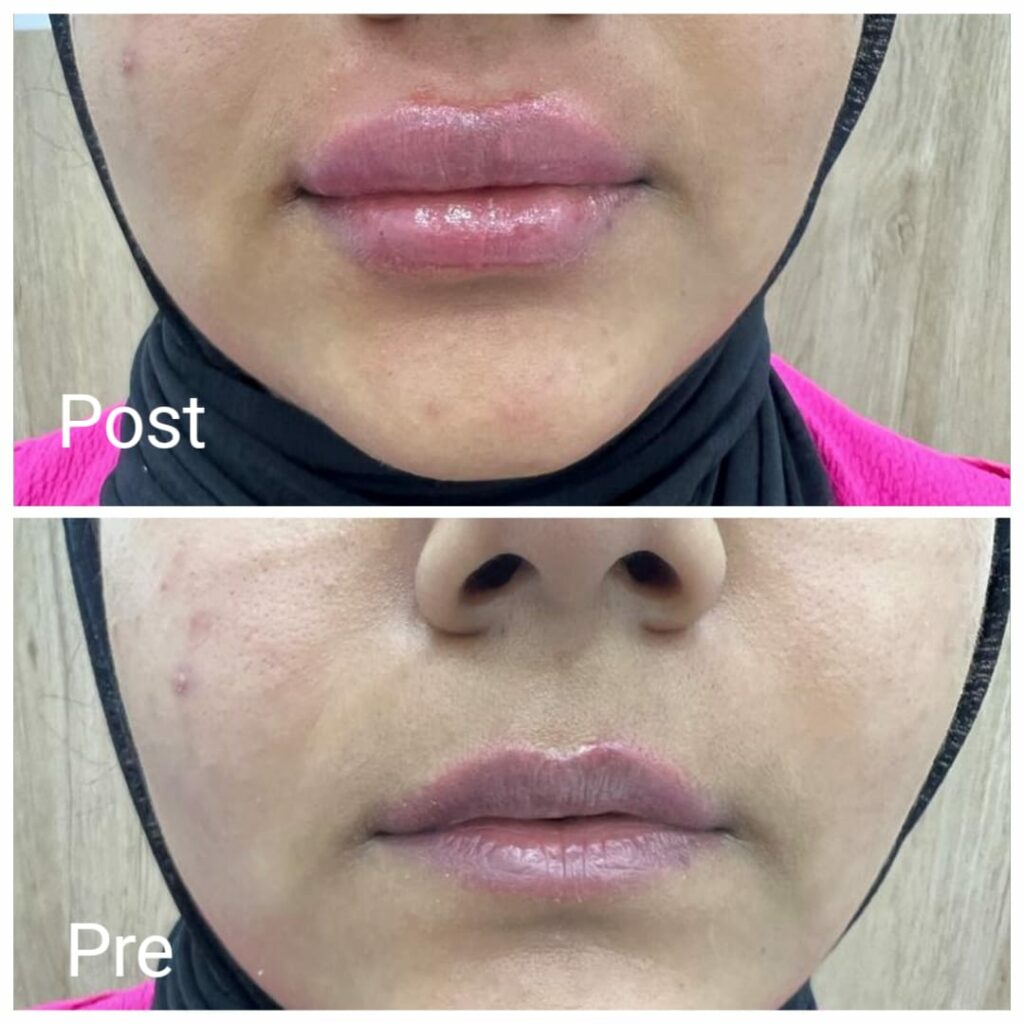 Lip augmentation with plasma fillers