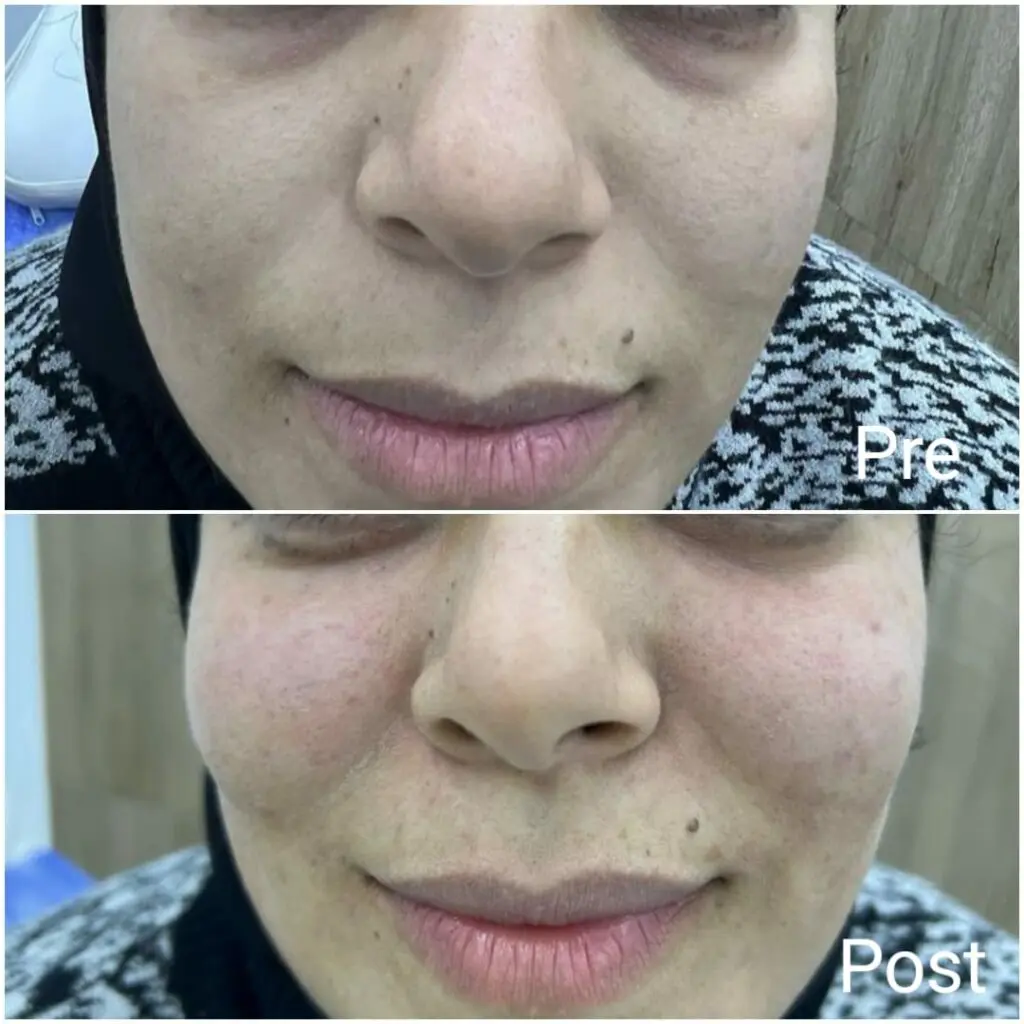 Plasma filler injections for cheeks