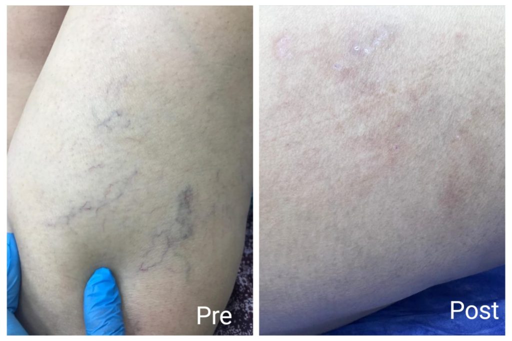 Permanent treatment of varicose veins
