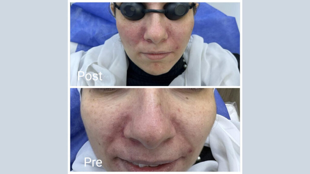 Plasma filler in Hurghada