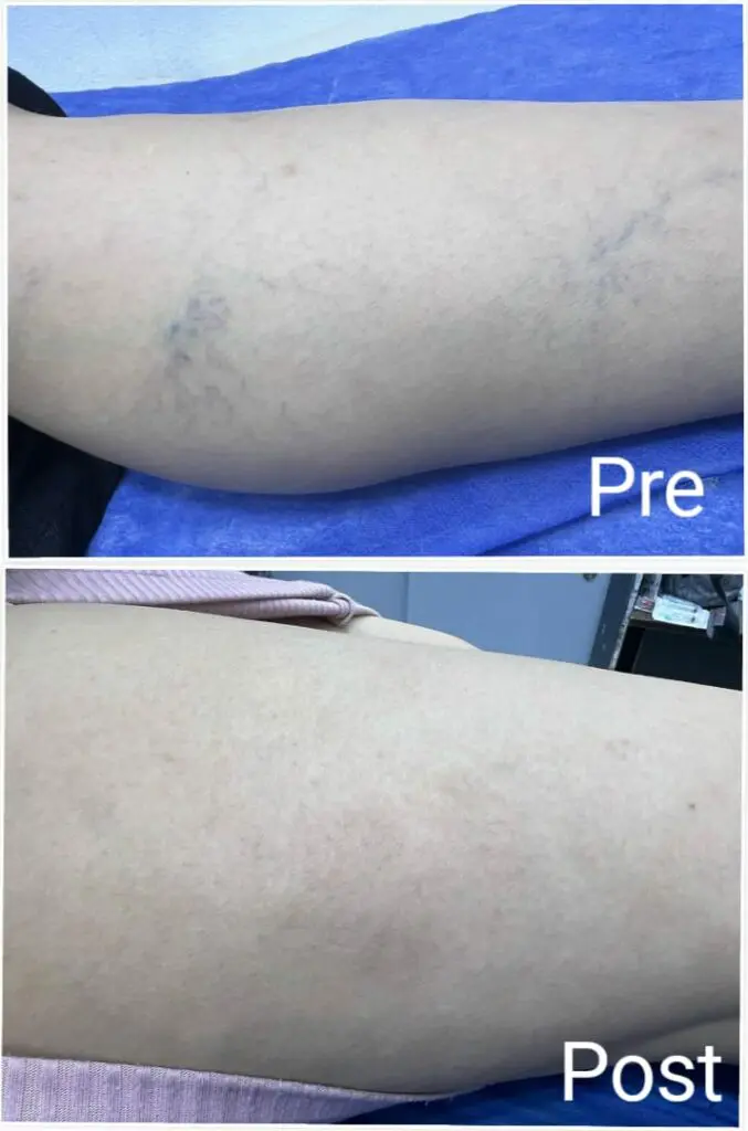 Results of varicose veins treatment before and after