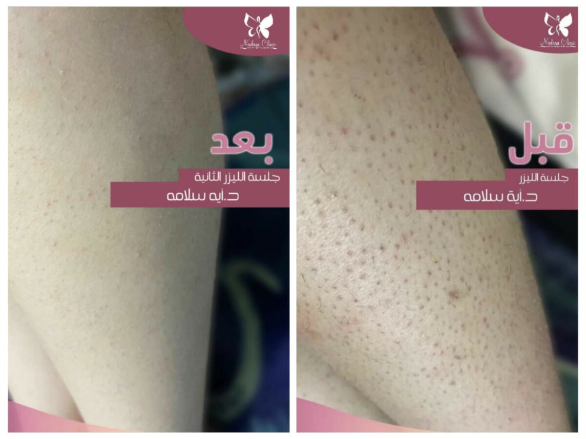 Keratosis pilaris treatment in Hurghada Book Now Nadara