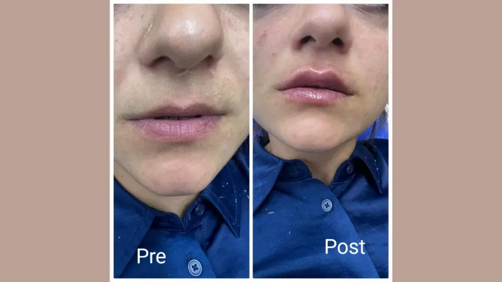 حقن الهيالورونيك في الغردقة