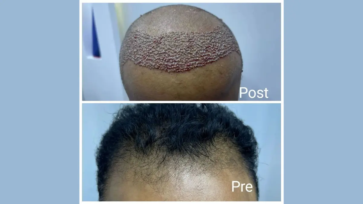 Forehead Reduction in Hurghada