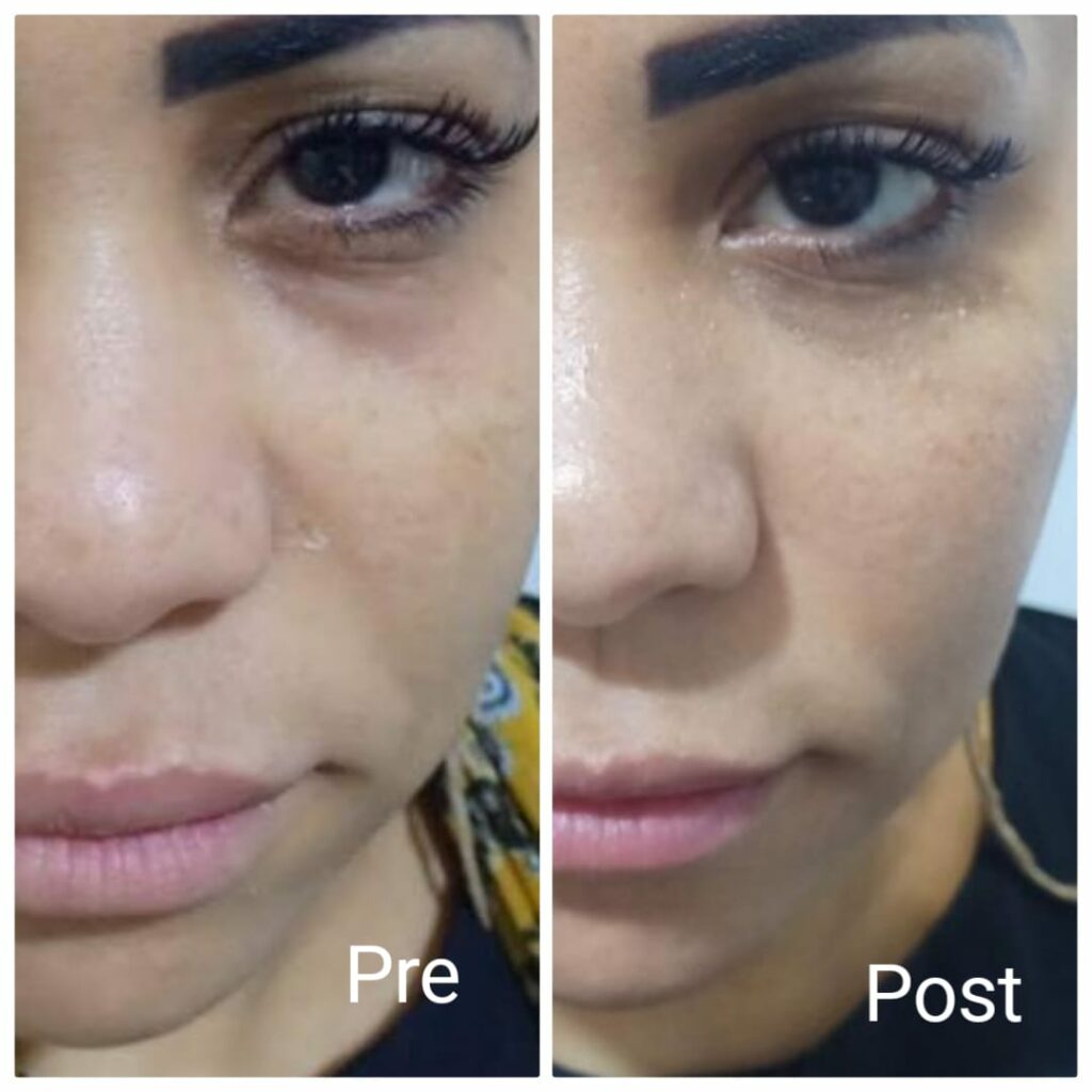 Remove bags under the eyes in Hurghada.