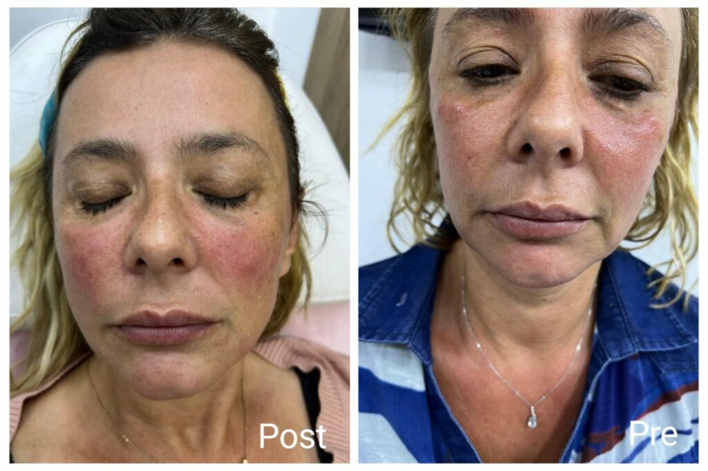 glutathione needles research #supplements #glutathione #antioxidant #antiaging #health #skin  #immunity #sports #multivitamin #detox main image 1