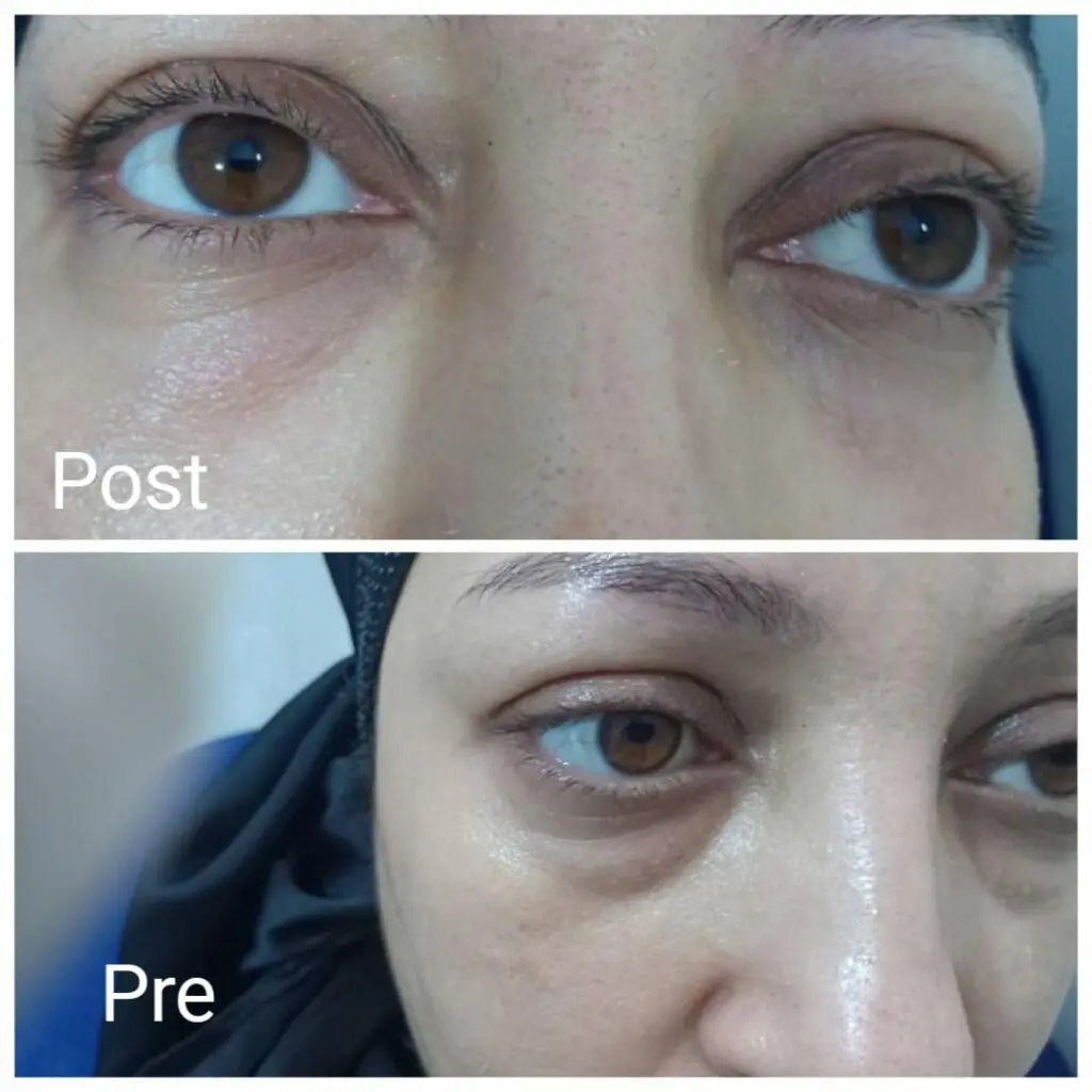 Remove puffiness under the eyes in Hurghada