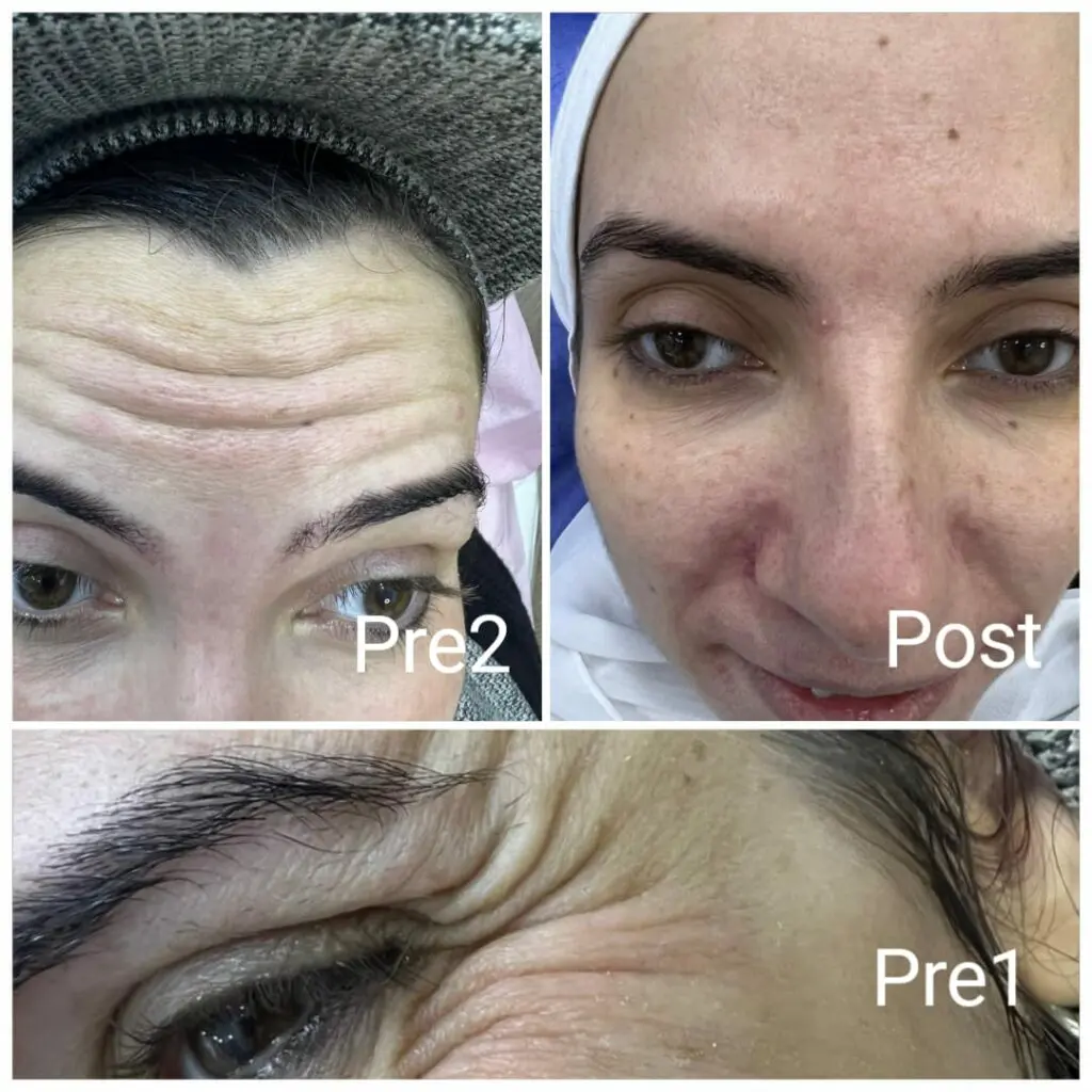 Botox on the forehead and around the eyes