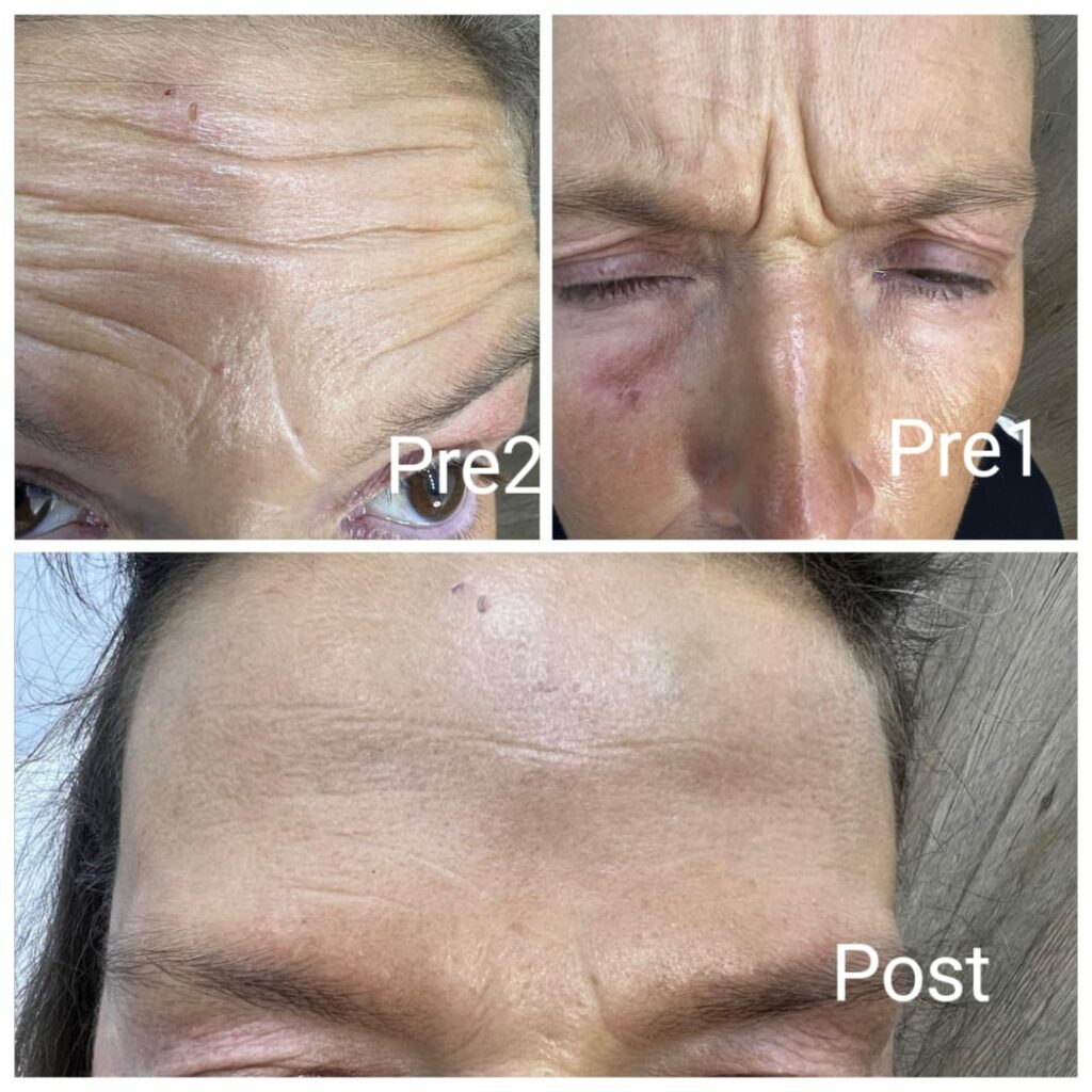 Botox for forehead wrinkles and between the eyebrows