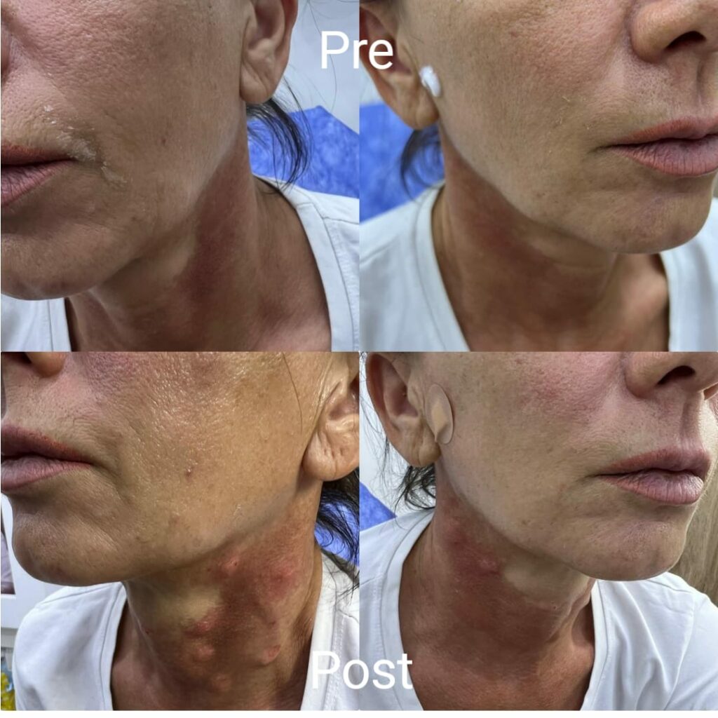 Jaw contouring before and after
