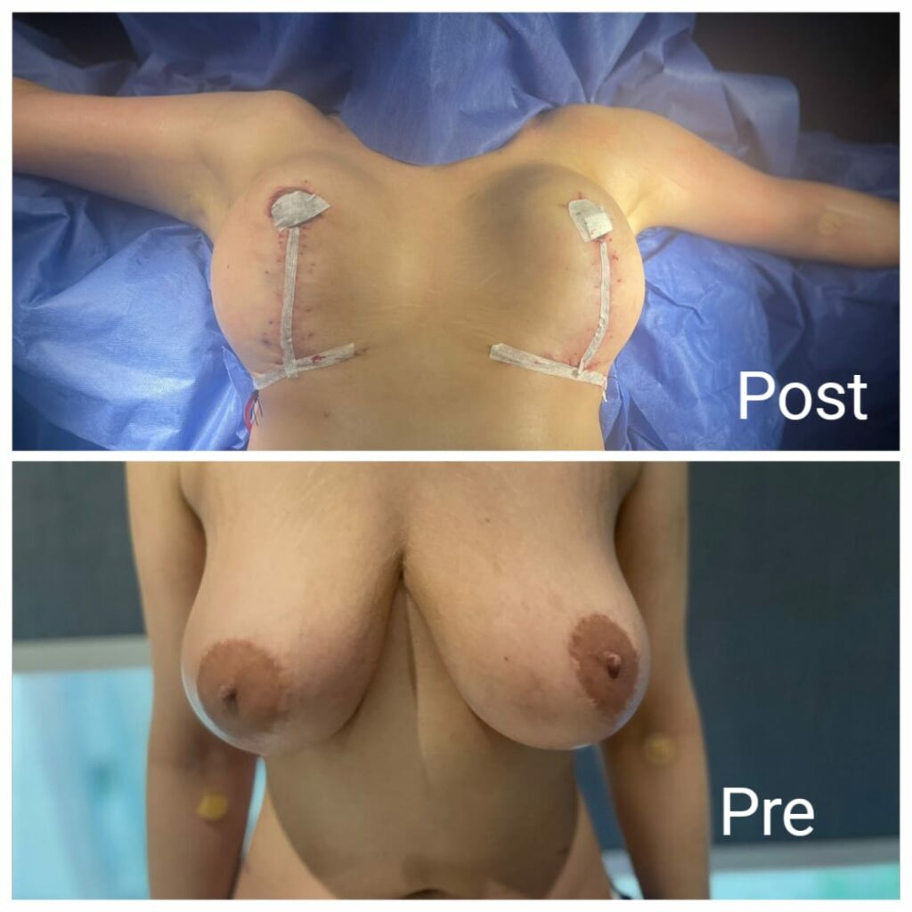 Breast reduction and lift surgery
