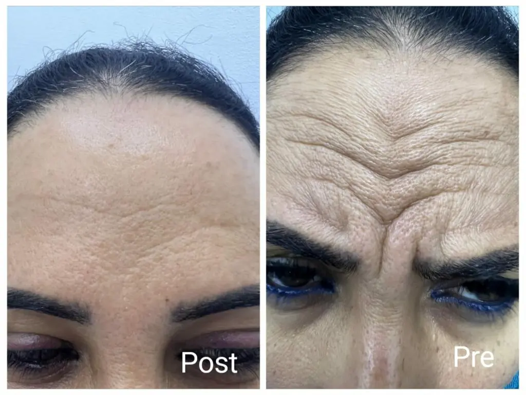 Botox injections for a forehead lift