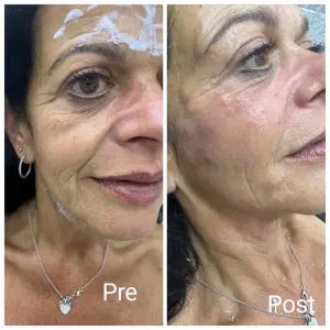 Sculptra injections before and after the first session