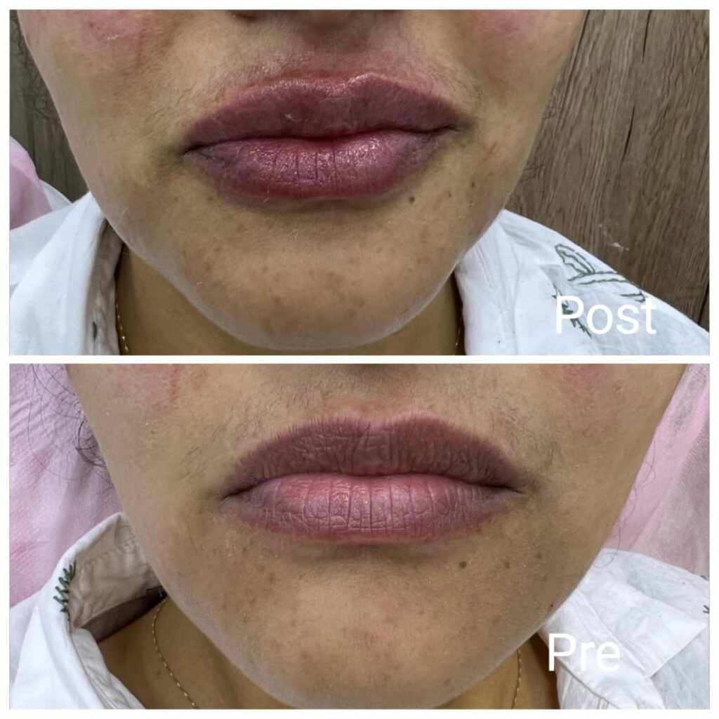 The result of lip filler injections